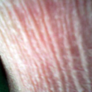 (Zeldzame huidziekte) Erythro-Keratoderme